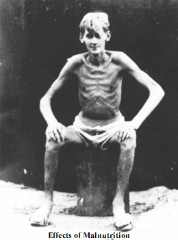 malnutrition